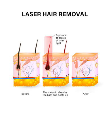 Dispositivo di depilazione laser portatile 810nm macchina permanente di depilazione per donna