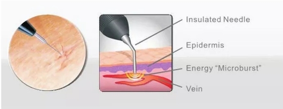 Salone di bellezza Macchina laser a diodo 980nm per sollievo del dolore / trattamento vascolare