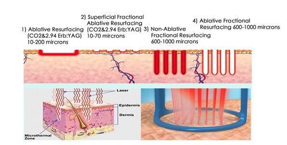 Eliminazione delle cicatrici Equipaggiamento di bellezza laser a CO2 con schermo LCD touch da 10,4 pollici