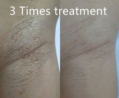 Dispositivo multifunzionale a diodo laser per la rimozione dei peli, supporta diverse larghezze di impulso per una riduzione permanente dei peli personalizzata