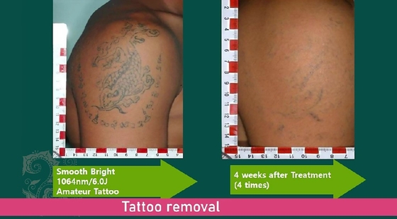 Macchina per la rimozione del tatuaggio in stile fisso Pico 3500W Macchina laser per il sbiancamento della pelle