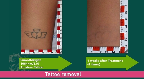 Macchina di rimozione tatuaggi laser Q Commerciale 1064nm 532nm 755nm
