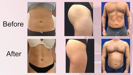 Salone di bellezza EMS Slimming Machine Tipo desktop Per perdita di peso / stretta della pelle