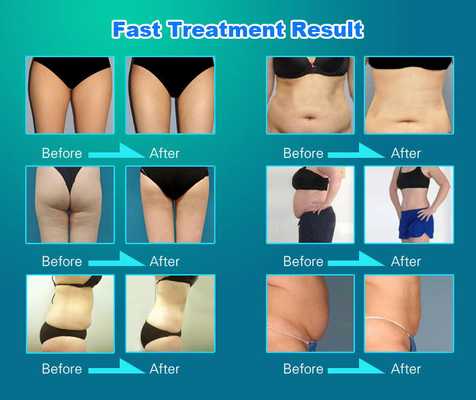 Macchina per la rimozione del grasso da cellulite a vuoto, macchina per dimagrimento da vibrazione 3500W