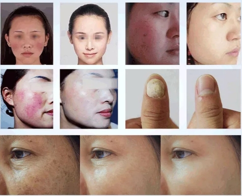 50W 980 Nm Diode Laser Spider Vein Removal Machine per il trattamento dei vasi sanguigni Soluzione