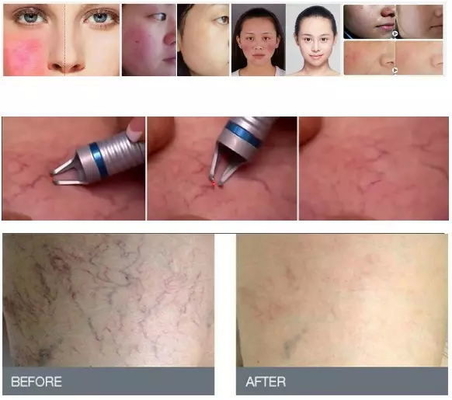 Ringiovanimento della pelle 980nm Diode Laser Machine Portatile Laser Spider Vein Removal Machine