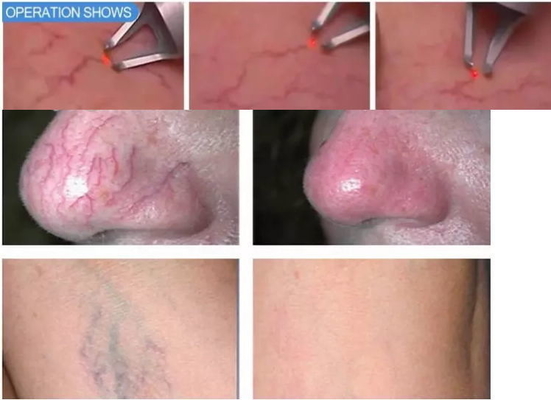 Ringiovanimento della pelle 980nm Diode Laser Machine Portatile Laser Spider Vein Removal Machine