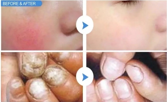 15W 30W Laser Vascular Removal Machine per il trattamento delle unghie / Ringiovanimento della pelle con laser caldo