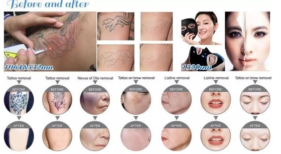 Macchina di rimozione del tatuaggio laser Nd YAG portatile 1064nm 532nm 1320nm Lunghezza d'onda