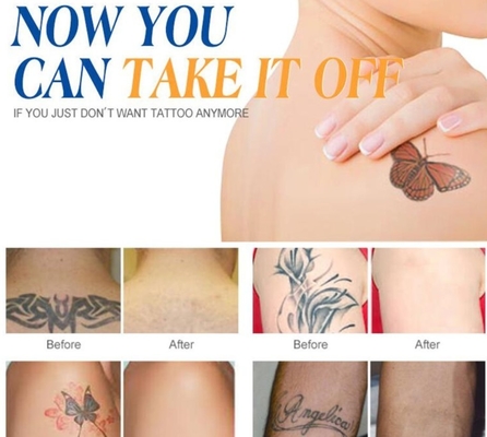Macchina laser Q Switch ND Yag personalizzata per la rimozione del tatuaggio / trattamento dell' acne