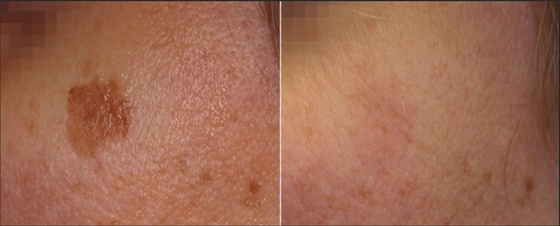 Macchina laser Q Switch ND Yag personalizzata per la rimozione del tatuaggio / trattamento dell' acne