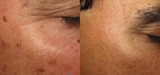 Macchina laser Q Switch ND Yag personalizzata per la rimozione del tatuaggio / trattamento dell' acne