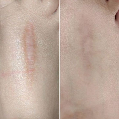 40w 60W macchina laser CO2 frazionata per rimozione delle rughe Stretch Mark Scar Removal Tightening