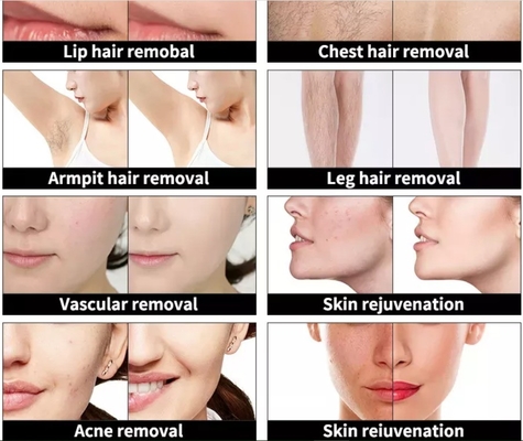 4 in 1 Macchina di bellezza multifunzione a tre lunghezze d'onda Laser per la rimozione dei capelli tatuati