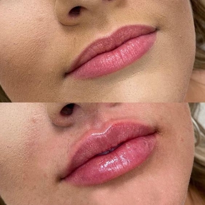 4 in 1 Macchina di bellezza multifunzione a tre lunghezze d'onda Laser per la rimozione dei capelli tatuati