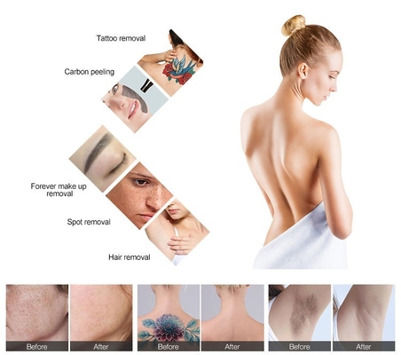2 in 1 laser a diodo Nd YAG laser depilazione senza Q-switch
