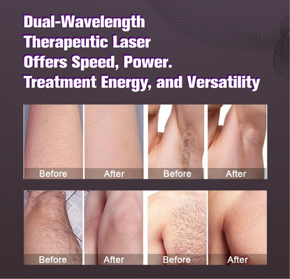 Large spot size candle laser alexandrite depilazione capelli bianchi REMOVAL 2000w alexandrite dispositivo laser