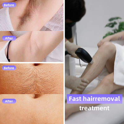 808 Diode Laser Ice Hair Removal Machine 4 lunghezze d'onda 1064nm Dimensione variabile del punto Sistema Android